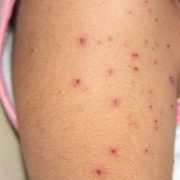 Recomienda la Secretaría de Salud