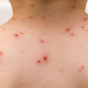 Aumentan casos de varicela en Campeche especialmente en niños