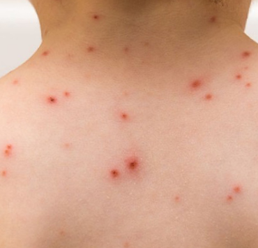 Aumentan casos de varicela en Campeche especialmente en niños