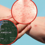 Nuevos casos de Sarampión en Campeche