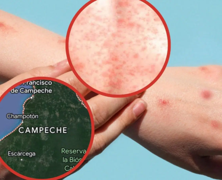Nuevos casos de Sarampión en Campeche
