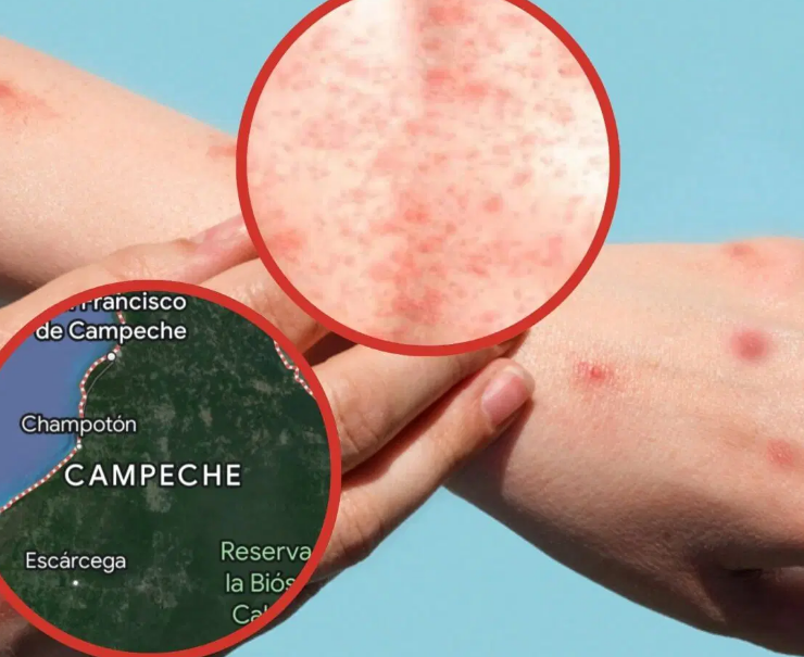 Nuevos casos de Sarampión en Campeche