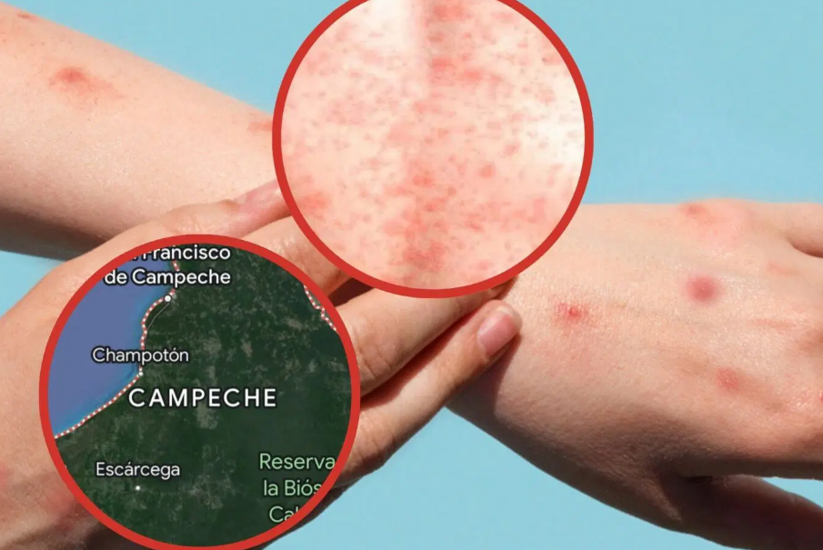 Nuevos casos de Sarampión en Campeche