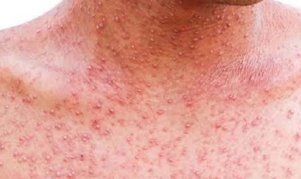 Refuerzan vacunación y medidas preventivas ante la enfermedad