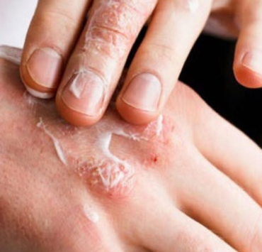 Crece contagio humano de sarna