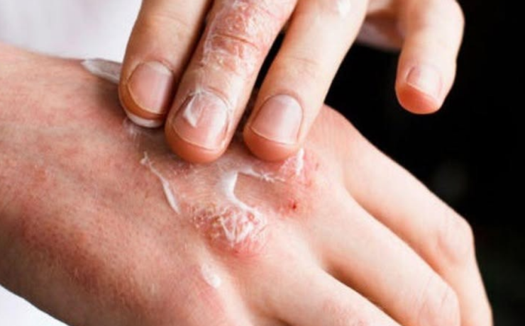 Crece contagio humano de sarna