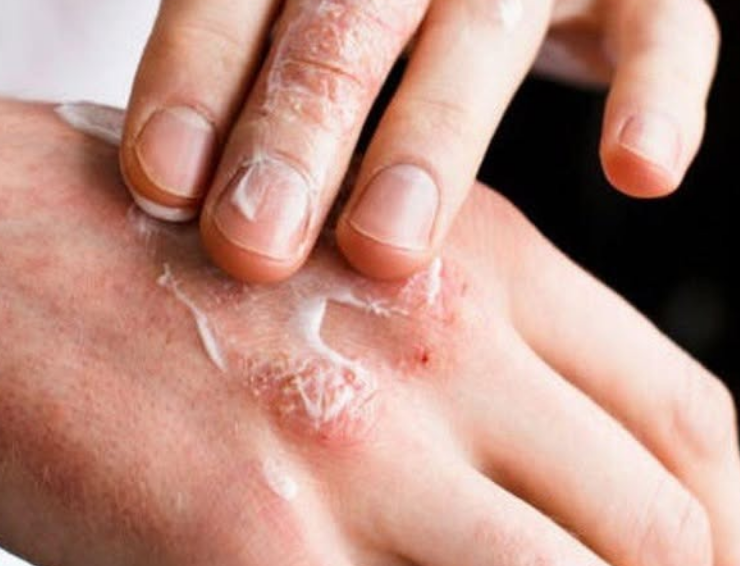 Crece contagio humano de sarna