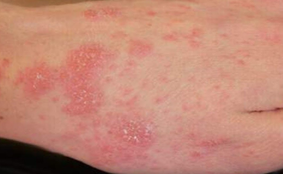 Crece el contagio humano de sarna: las cifras que preocupan